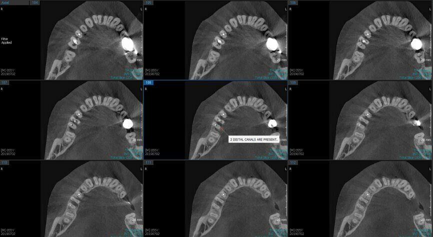 Fig.2c: Pre-op CBCT images of tooth #46: No obturation material in the distal and mesiobuccal canal (a); scanty obturation of the canals and breach of the floor of the pulp chamber, no obturation beyond a few millimetres down the orifice (b & c); radiolucency in the furcation area and periapical region of both roots (d -g).