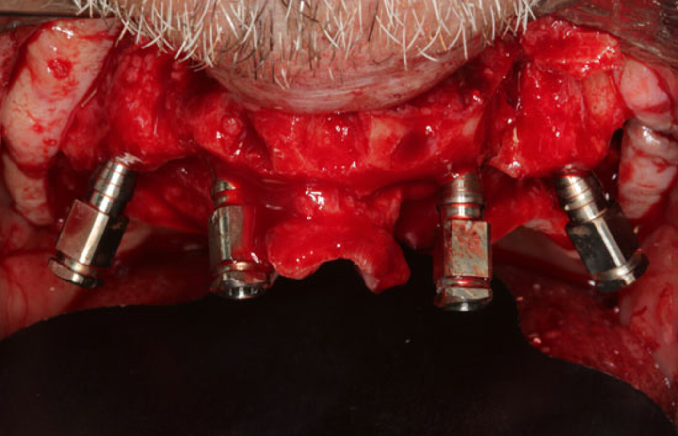 Fig. 13. ColocaciÃ³n de cuatro implantes, dos anteriores rectos y dos distales angulados 30 grados (âall-on-fourâ). 