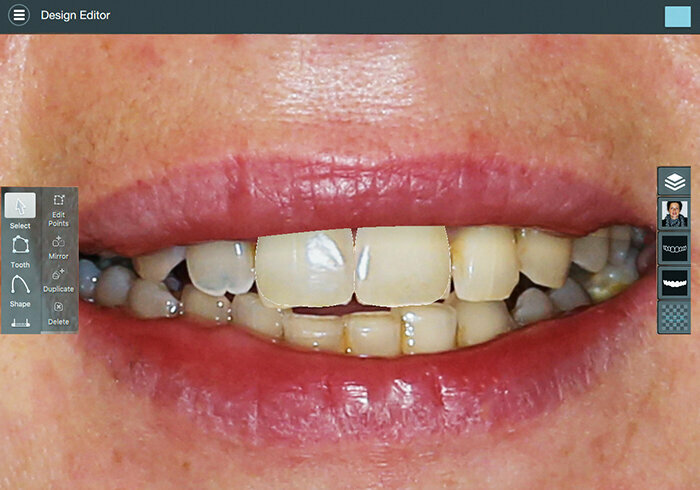 Fig. 2: With the software Smile Designer Pro, ideal middle incisors were constructively simulated.