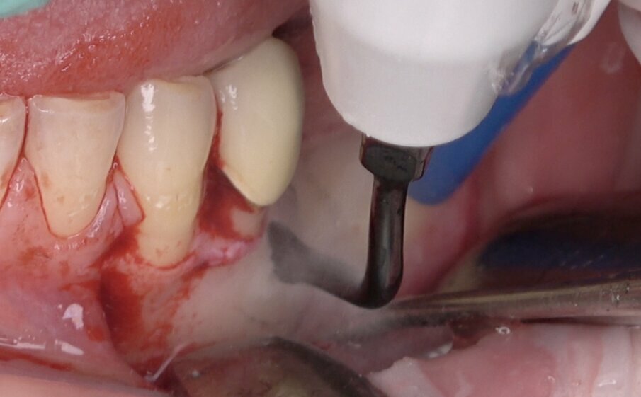 Fig. 5 - Utilizzo del terminale piezoelettrico (Esacrom) per creare il box osseo che permettere di accedere al dente incluso.
