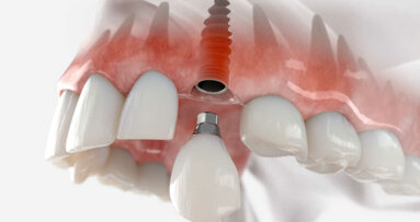 Pesquisadores na Austrália buscam melhorar os resultados dos implantes dentários