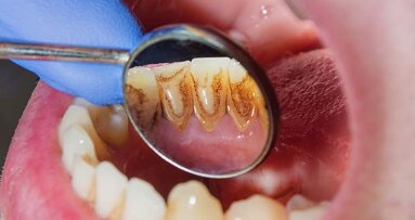 New research provides faster cheaper method to treat periodontitis