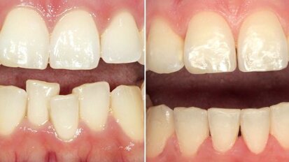 Gerade Zähne in Rekordzeit: Zahnarzt erklärt innovative Behandlungsmethode