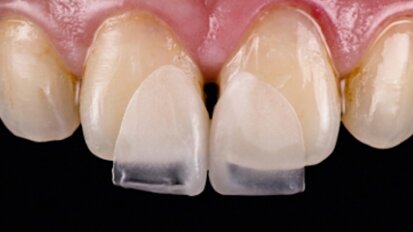 Fig. 4. Las microcarillas delgadas en los dientes 11 y 21 durante la prueba clínica en boca.