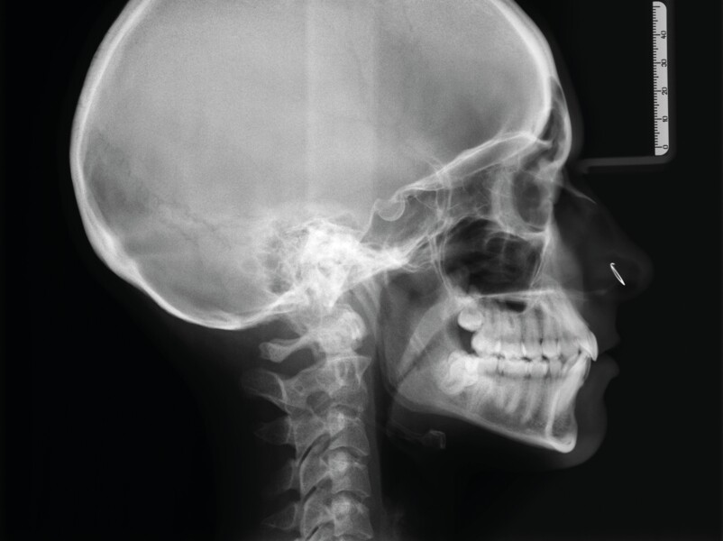 Fig. 3 : Radiographie céphalométrique initiale 