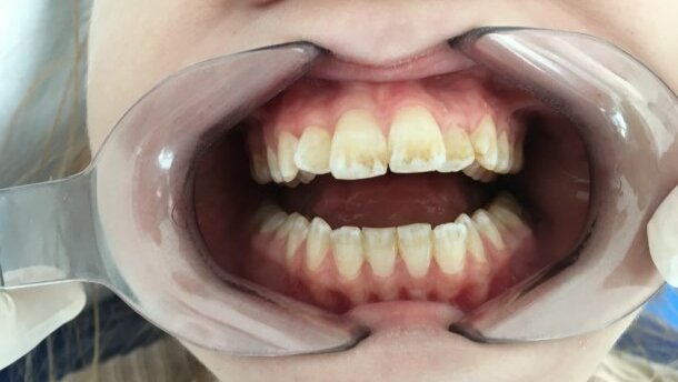 Stan zdrowia jamy ustnej u chorych na mukowiscydozę – przegląd literatury
