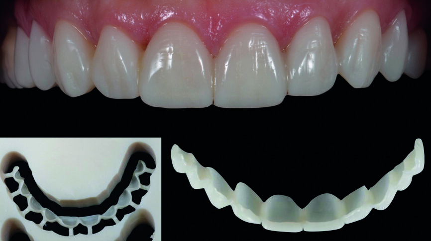 Fig. 12b : Restaurations provisoires en bouche (Telio CAD). 