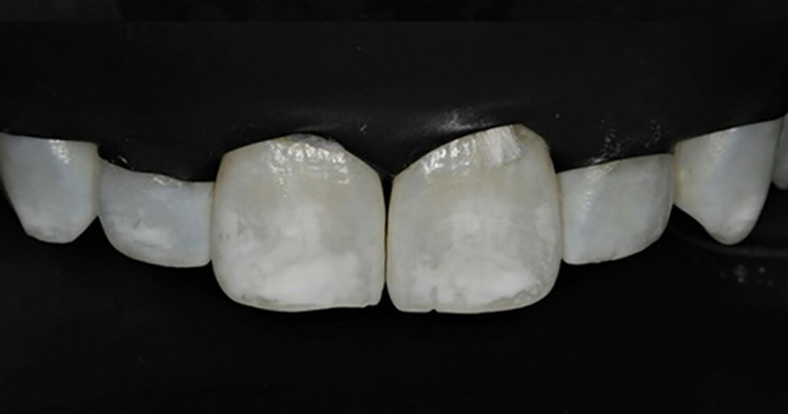 Fig. 4a: Maxillary canine to canine view under dental dam isolation. Before resin inltration treatment.