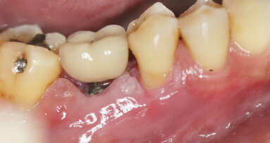 Periimplantitis - druga najčešća komplikacija nakon terapije dentalnim implantatima