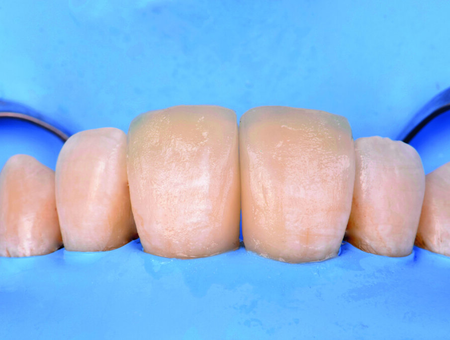 Fig 13. Restored central incisors before finishing and polishing