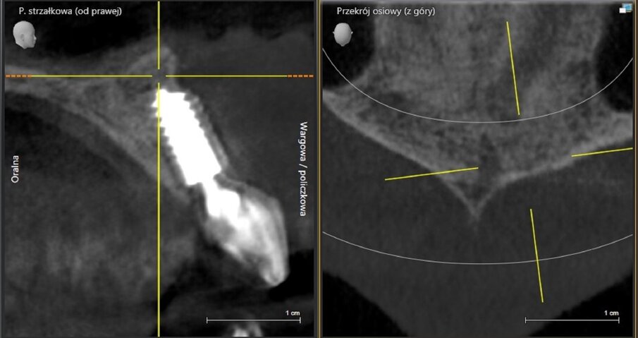 Fig. 19: CBCT 1,5 ano pós-operatório.  Regeneração óssea visível.