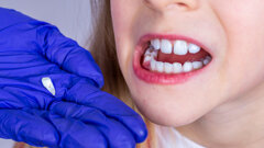 Linie wzrostu zębów mlecznych mogą pomóc w ocenie ryzyka rozwoju zaburzeń psychicznych
