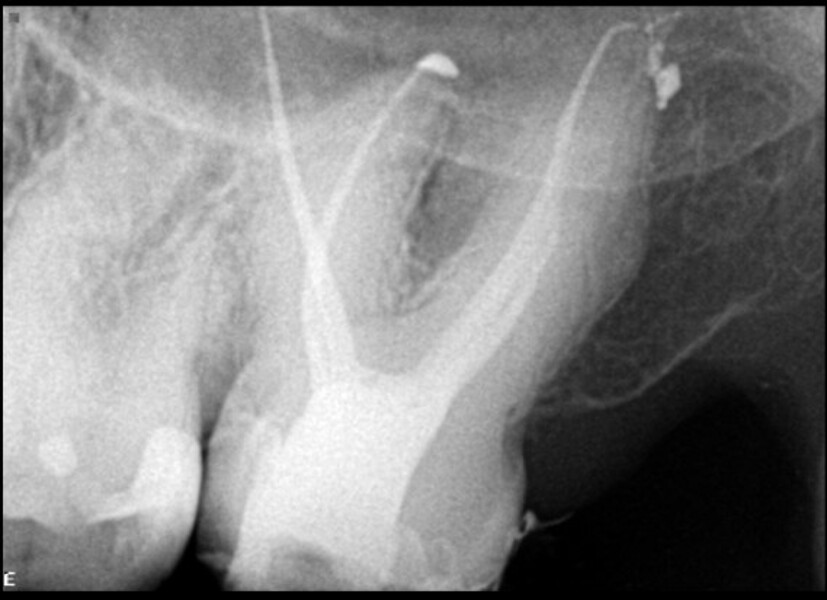 Fig. 7b: Immediate post-op radiographs showing 3D filling of the root canal system at different angulations.