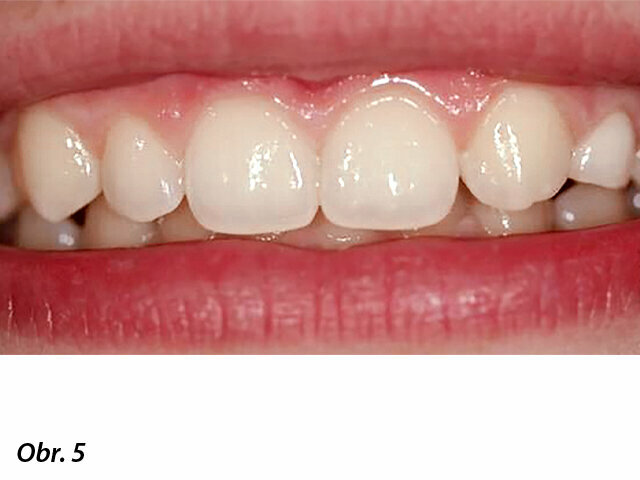 Výchozí stav po ukončení ortodontické léčby u 2. případu.