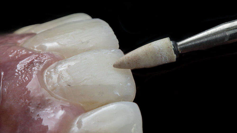 Predictable steps to Biomimetic Class IV restorations