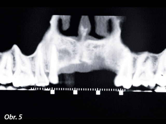 Oblast po odstranění implantátu vykazovala ještě větší úbytek objemu kosti.