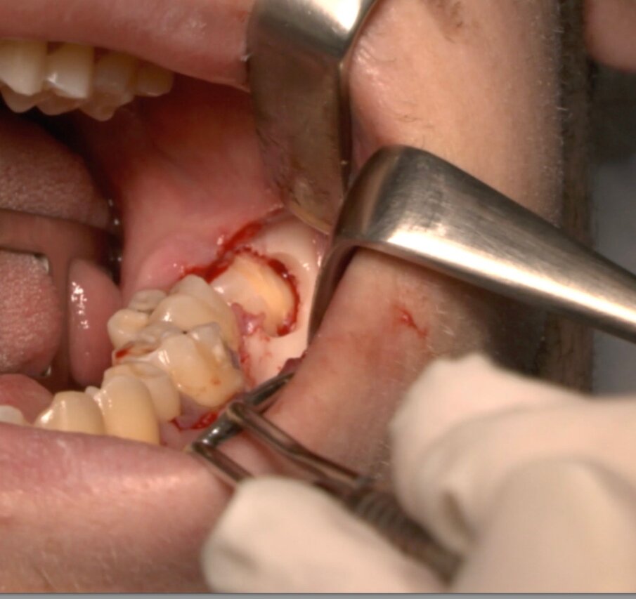Fig. 8_Odontotomia. Il taglio si trova fra la zona di massima circonferenza e la giunzione smalto cemento.