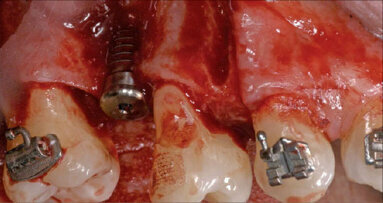 Chirurgicky akcelerovaná ortodontická terapie jako součást multidisciplinární implantologické léčby