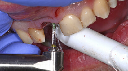 The use of new technologies and digital implant solutions in a one-stage surgical procedure