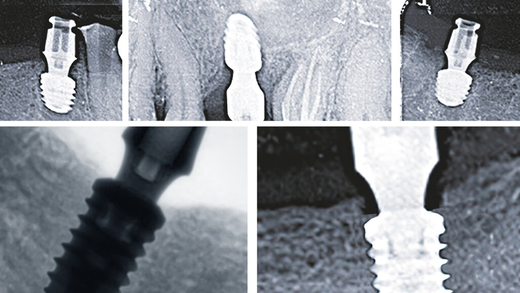 Improved osseointegration thanks to bredent’s Bone Growth Concept
