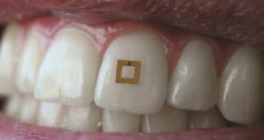 New tooth-mounted microchip tracks ingested food