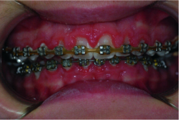 Clinical view, showing gingival enlargement, just before the debonding procedure.