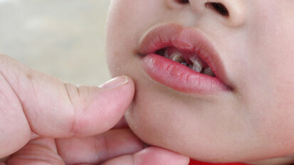 Hypominéralisation de l'émail : une étude pointe du doigt les anti-inflammatoires couramment utilisés chez les enfants