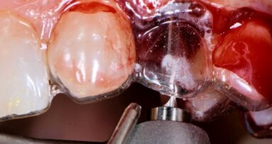 Alternatywne leczenie implantoprotetyczne przy wrodzonej hipodoncji siekaczy