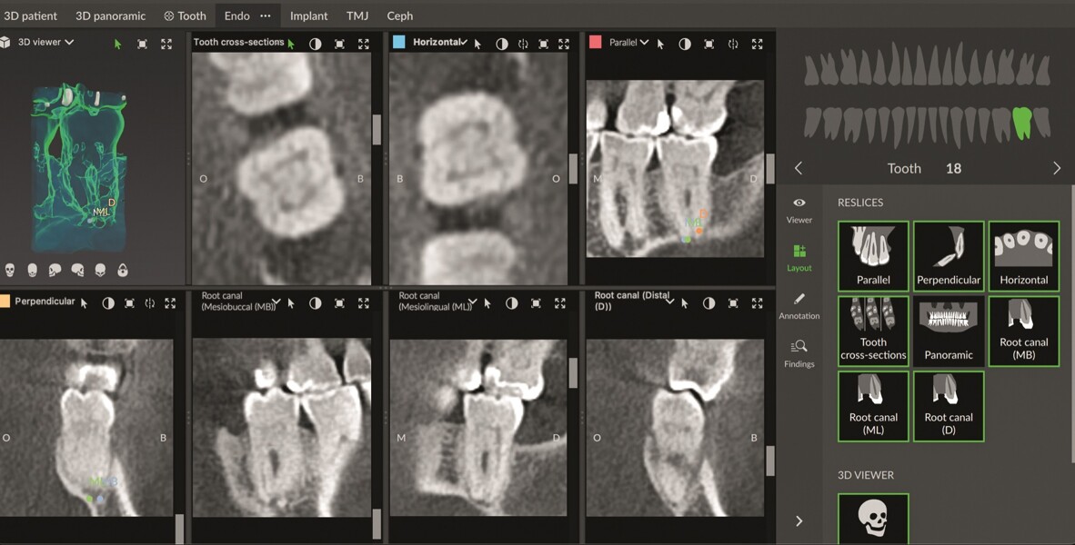 Fig. 9 : Différentes coupes en mode endodontique de DTX Studio Clinic pour l’analyse du cas.