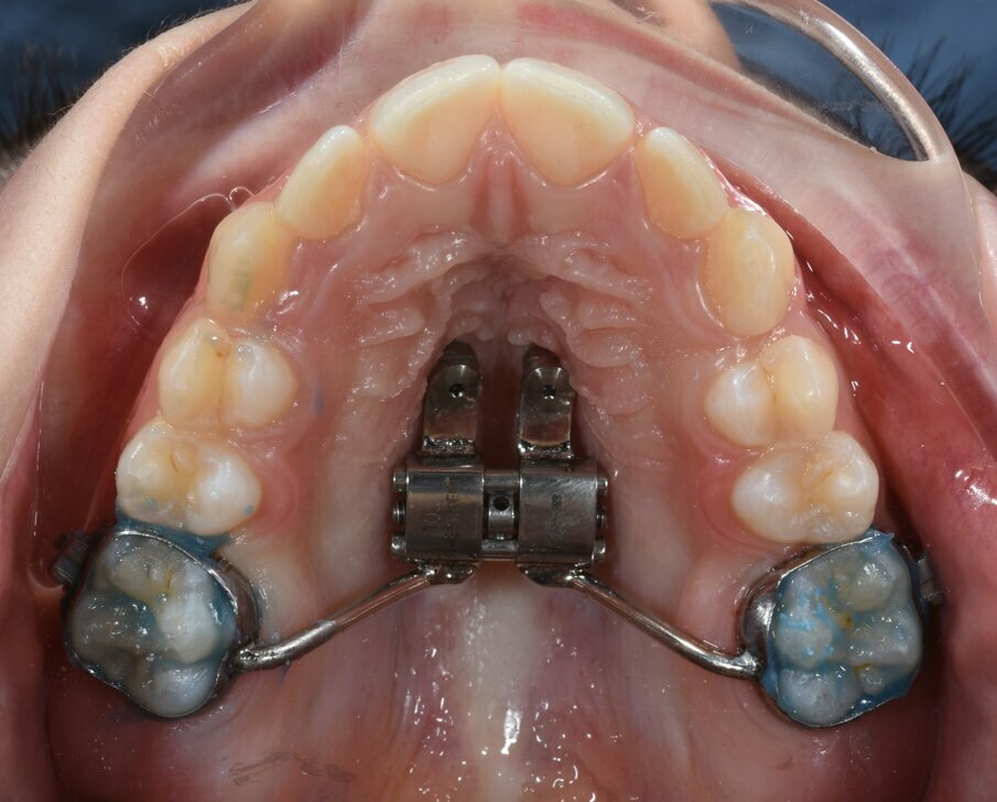 Fig. 5b_Applicazione in un’unica seduta di espansore palatale ibrido ad appoggio dentale e scheletrico.