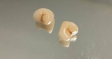Substitution of two destructive caries with ceramic CAD/CAM crowns in one visit