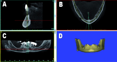 3-D virtual planning concepts for implant-retained full-arch mandibular prostheses: The bone reduction guide