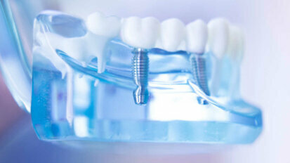 Une nouvelle technologie pourrait améliorer l’intégration des implants dentaires métalliques