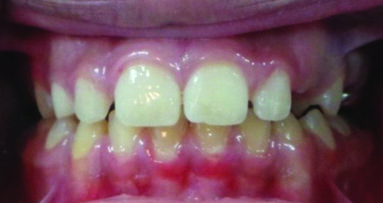 Clinical Management Approach of Molar Incisor Hypomineralisation. A case report.