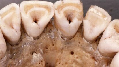 Shovel-shaped incisors a result of genetic mutation from last ice age