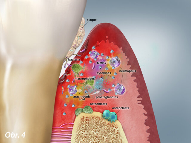 Obr. 4: Počáteční chronická léze – parodontální tkáň: Zvýšená retencezubního mikrobiálního povlaku, rozpad periodontálních vazů a tvorba ulcerací na epiteliální výstelce, počátek resorpce kosti. Buněčná úroveň: Zvýšený počet neutrofilů, makrofágů a dalších. Biochemická úroveň: Zvýšená prozánětlivá aktivita cytokinů, arachidonová kyselina pokračuje v produkci prostaglandinu, uvolňuje se i MMP.
