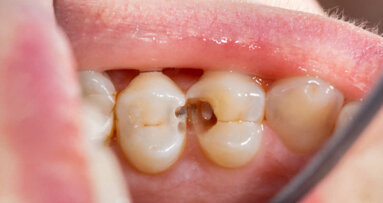 Študija ponuja nov vpogled v parodontalno bolezen in obrambni odziv telesa