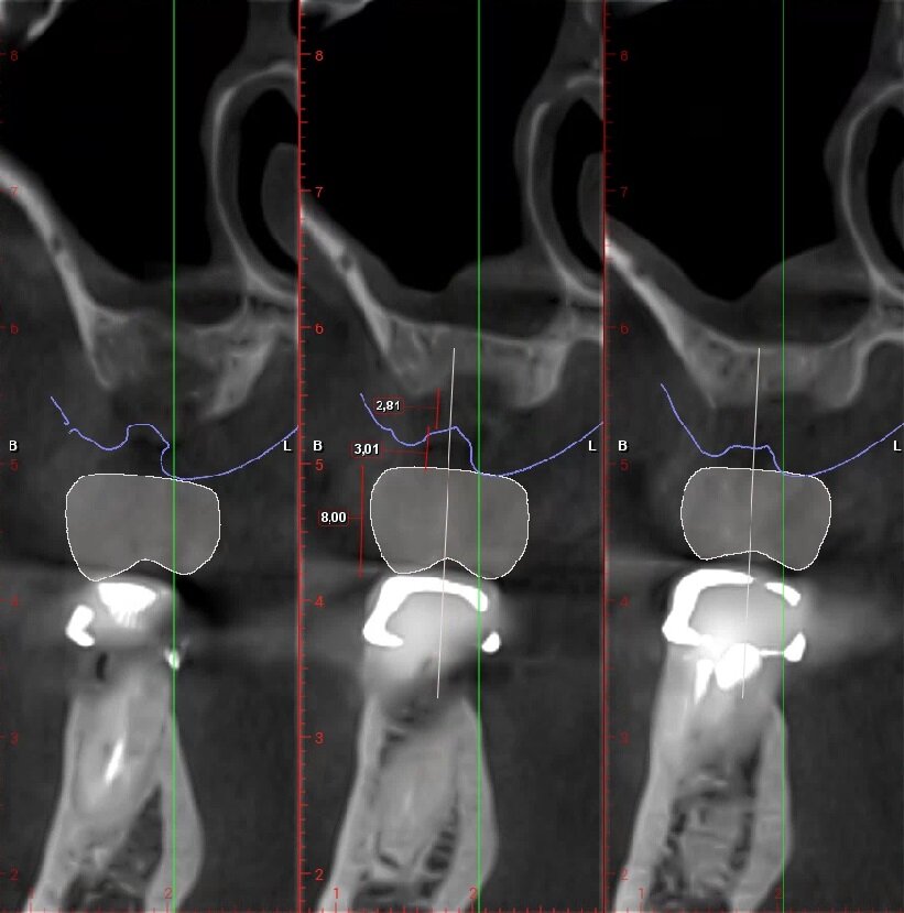 Fig. 5_Ceratura diagnostica elemento 2.6. Dimensione Corono-apicale della corona congruente con elemento controlaterale 8,00 mm, tragitto trans-mucoso 3,01 mm, entità della rigenerazione ossea verticale necessaria 2,81 mm.