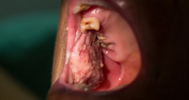 Cancerul oral poate trece nedetectate în timpul crizei COVID-19