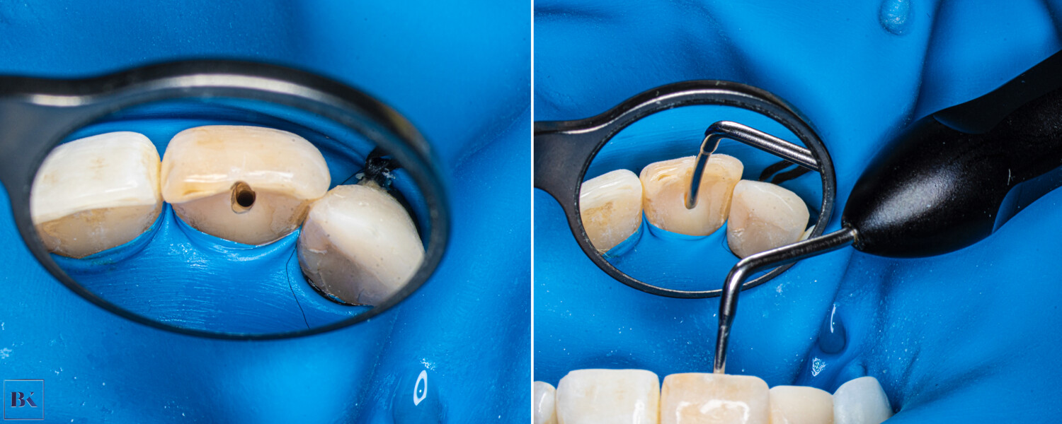 Figs. 8a & b: Final preparation (a). The size of the access cavity and of the root canal orifice was checked with the #80 hand plugger (b).