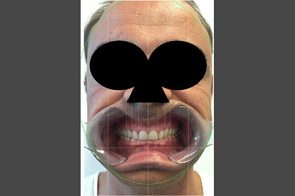 Fig. 4. Protocolo DSD: imagen del paciente sonriendo con un retractor de labios y mejillas.