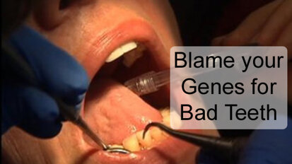 Blame your Genes for Bad Teeth