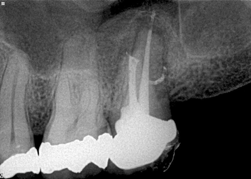 Fig. 5: The case was referred for retreatment due to the failure of the previous root canal therapy. Following the shaping (TF-adaptive) and cleaning (Sleiman protocol), and upon the challenging but successful search for the distal canal, a 3-D obturation was performed, which allows showing the isthmus between the mesial and distal canals as well as a very coronally located lateral canal in the palatal root.