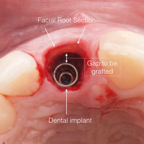 Fig. 21: Clinical view showing the intact root serving as a buccal shield, the implant in place and the gap to be filled with bone substitute material.