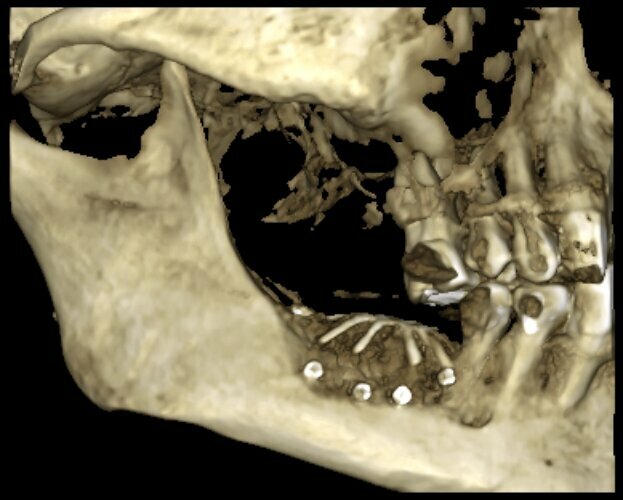 Figg. 9, 10_La situazione radiologica e clinica a 6 mesi dalla chirurgia, si esegue la riapertura attraverso una singola incisione crestale.