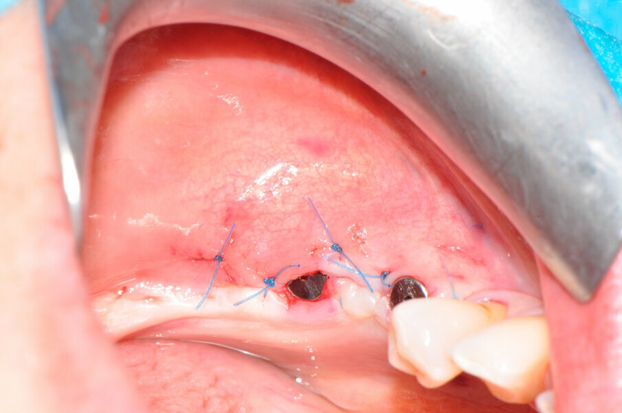 Fig. 8 - La sutura al termine dell’intervento.