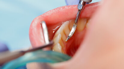Uno studio offre nuove informazioni sullo sviluppo e la prevenzione della carie dentale