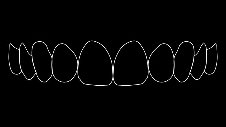 Figura 3. Simulación numérica de la sonrisa ideal.