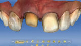 Fig. 4. Los límites de la preparación en los dientes 11 y 21 se establecieron en el software CEREC.
