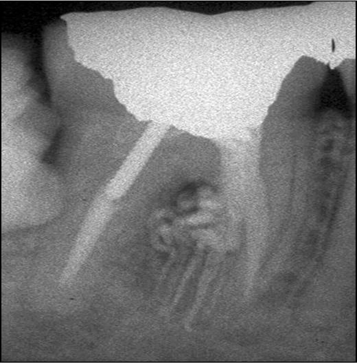 Buccal root of the bifurcated maxillary premolar—a danger zone during